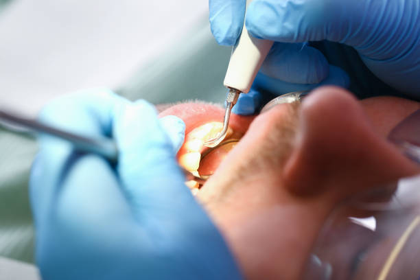 Best Emergency Tooth Extraction in Nags Head, NC